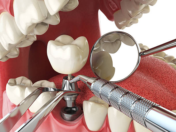 Teeth Whitening in AL